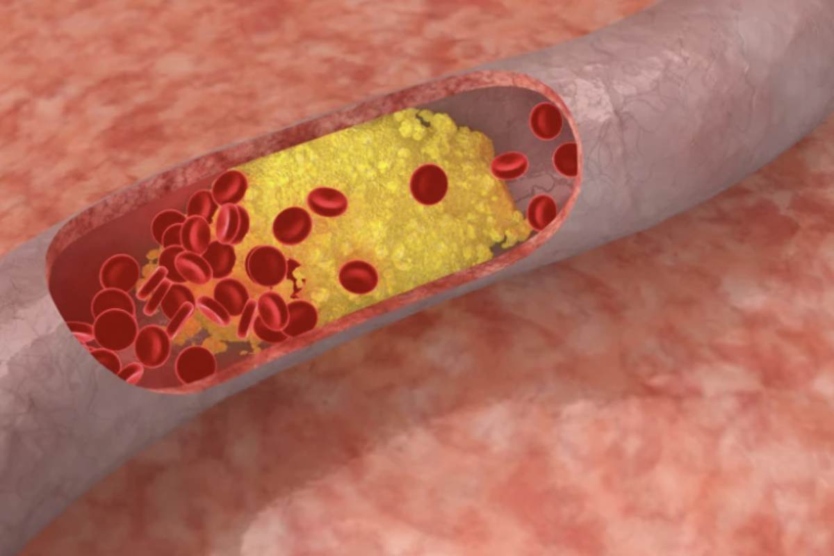 L’analisi della colesterolemia è uno degli esami più prescritti per valutare la salute del sistema circolatorio.
